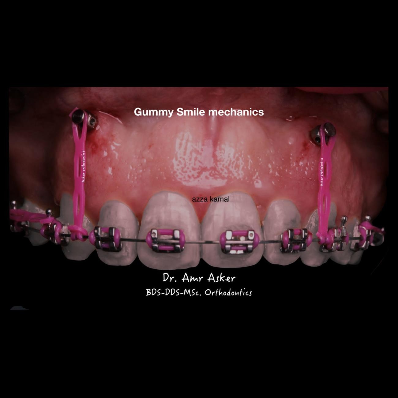 Vertical traction of labially erupted canines image