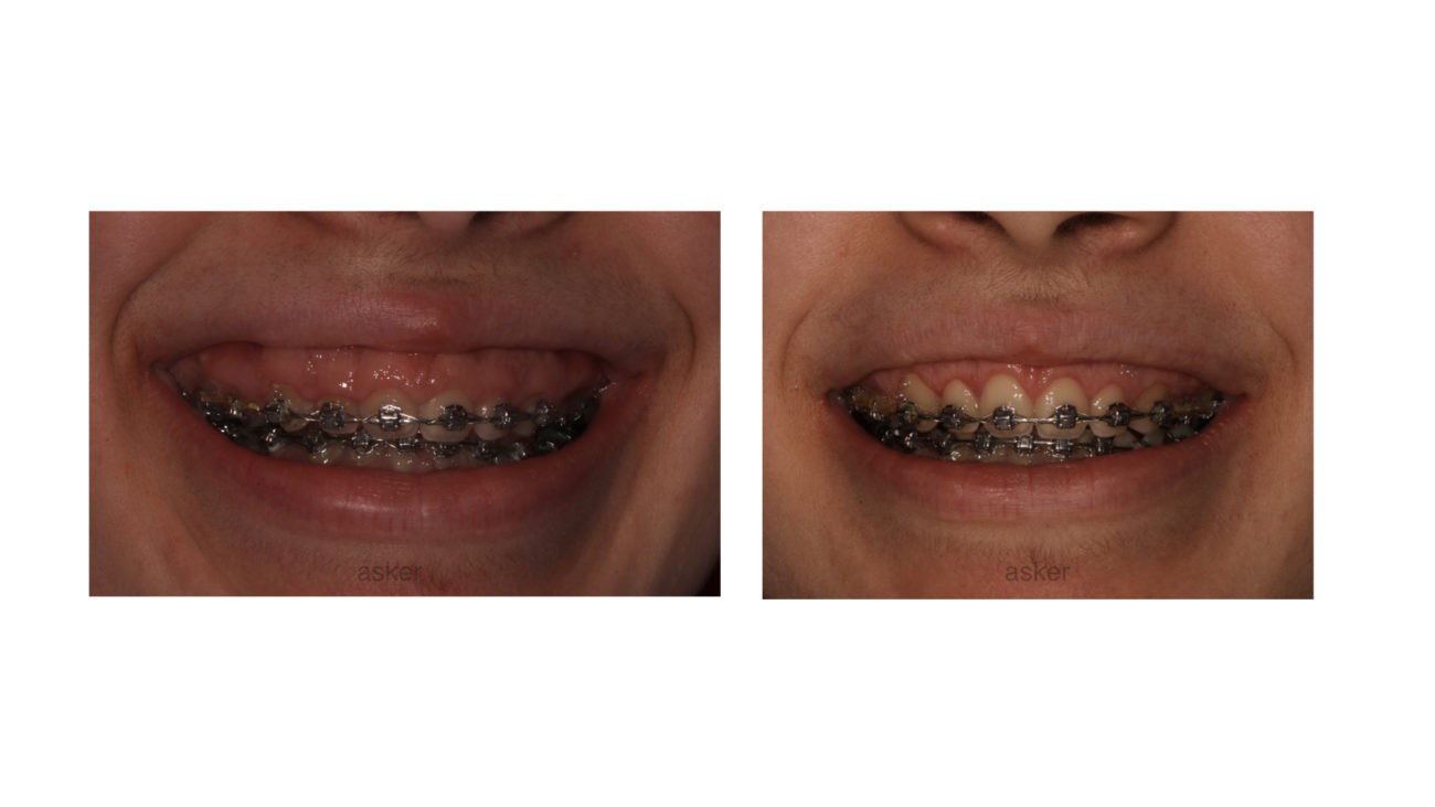 Gummy smile mechanics image