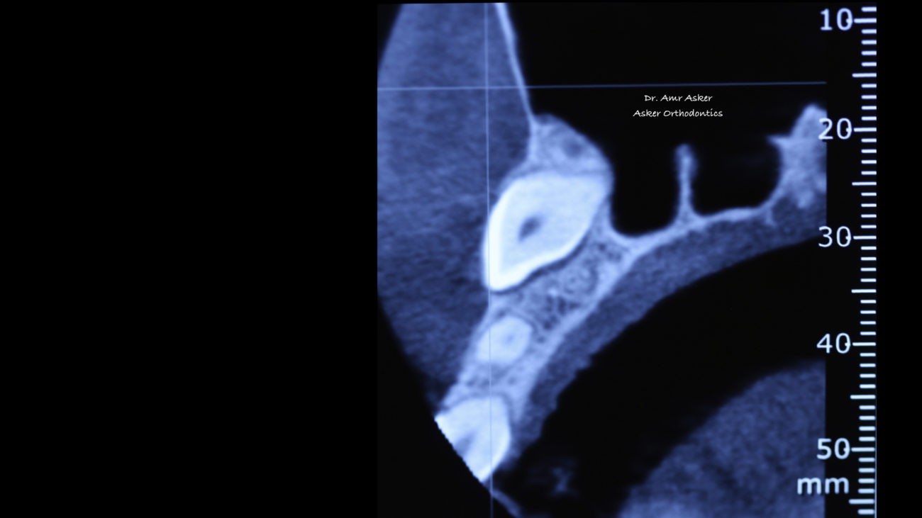 Labially impacted canine traction image