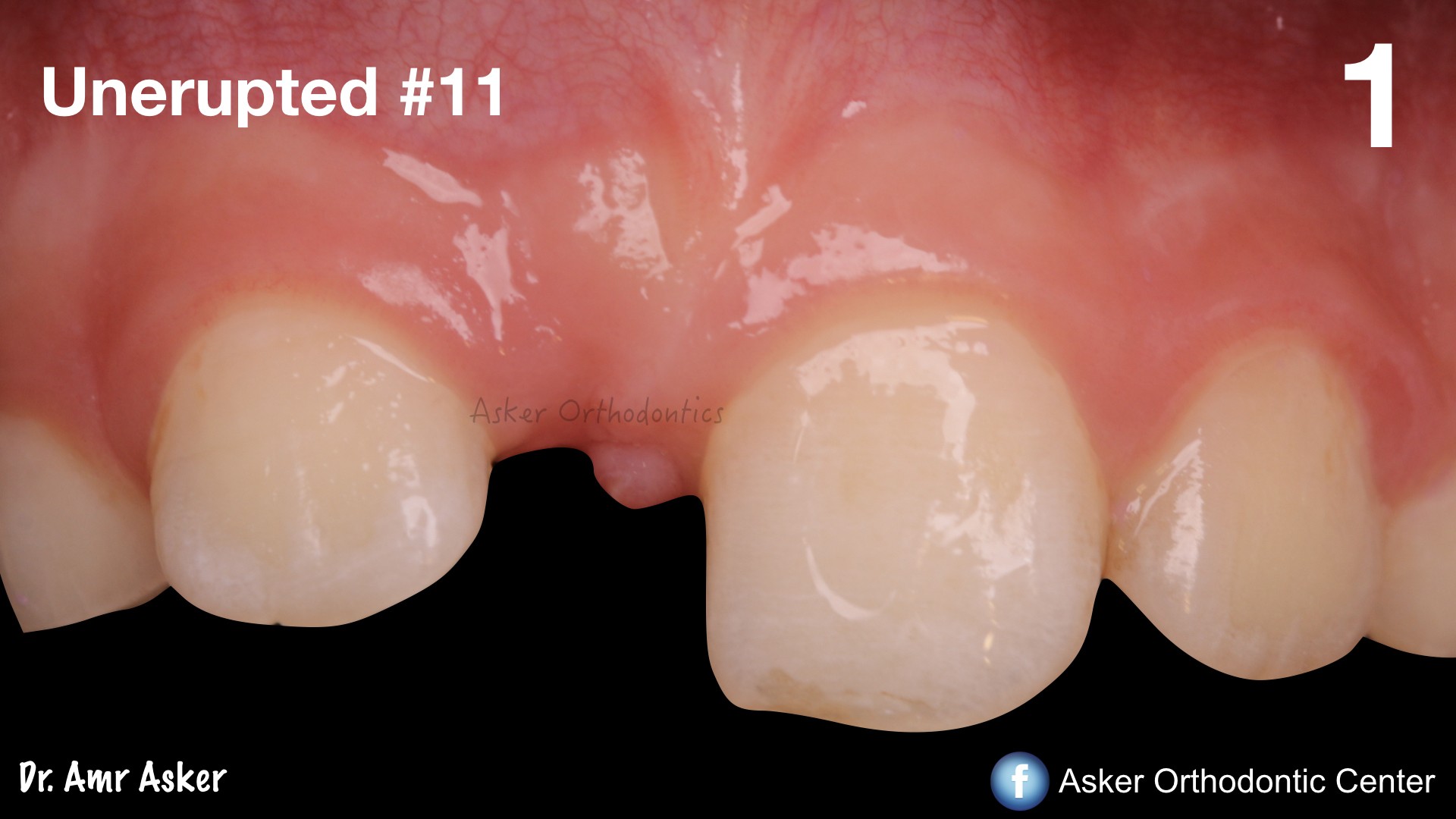 impacted central traction image