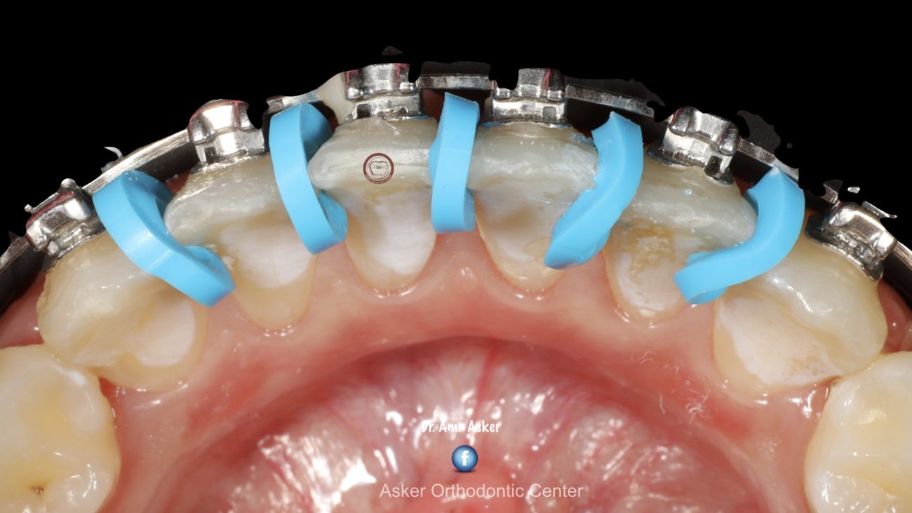 Fixed retainer bonding with the aid of separators image