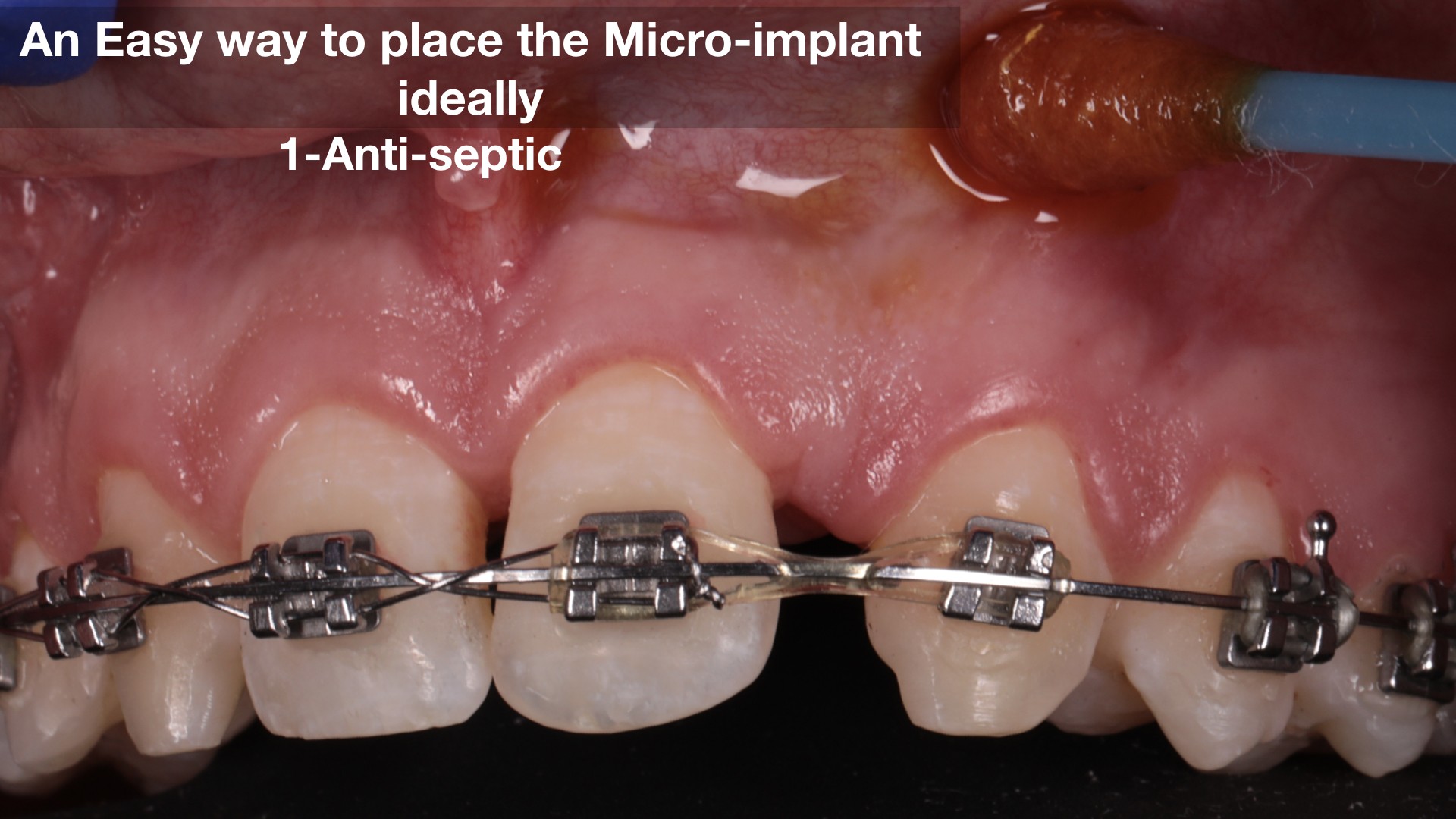TAD INSERTION, STEP BY STEP image