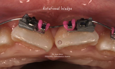 ROTATIONAL WEDGE image