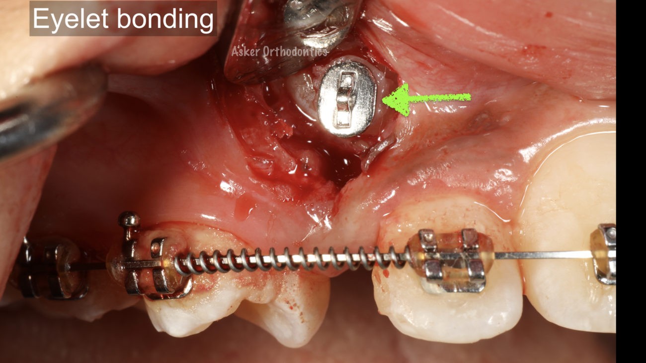 Closed traction of labially impacted canine image