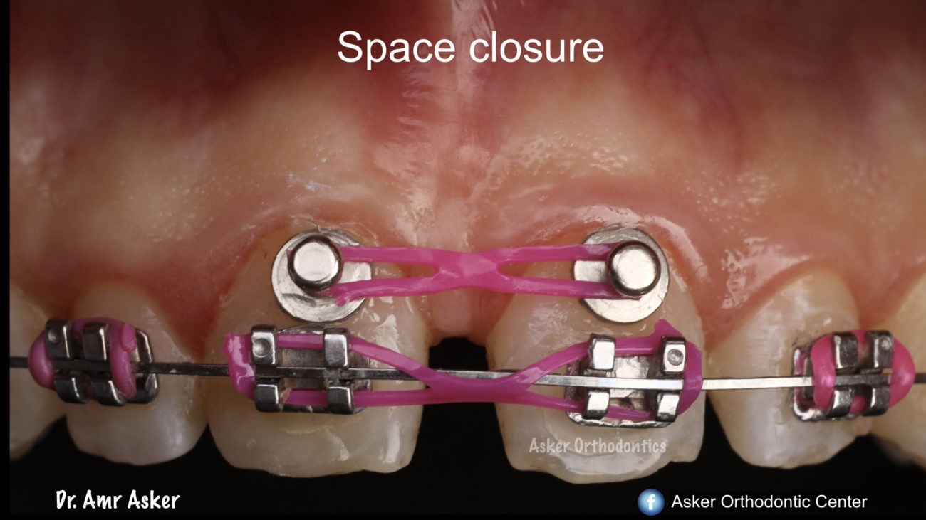 diastema closure image