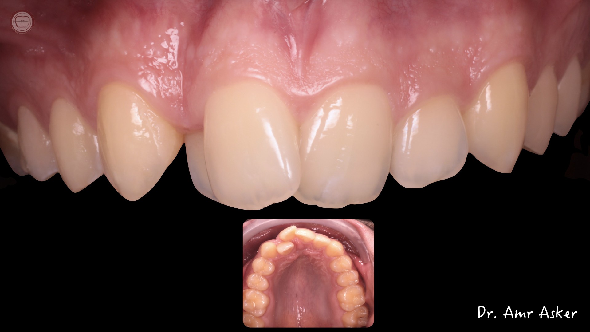 SPACE OPENING FOR BLOCKED LATERAL, STEP BY STEP image