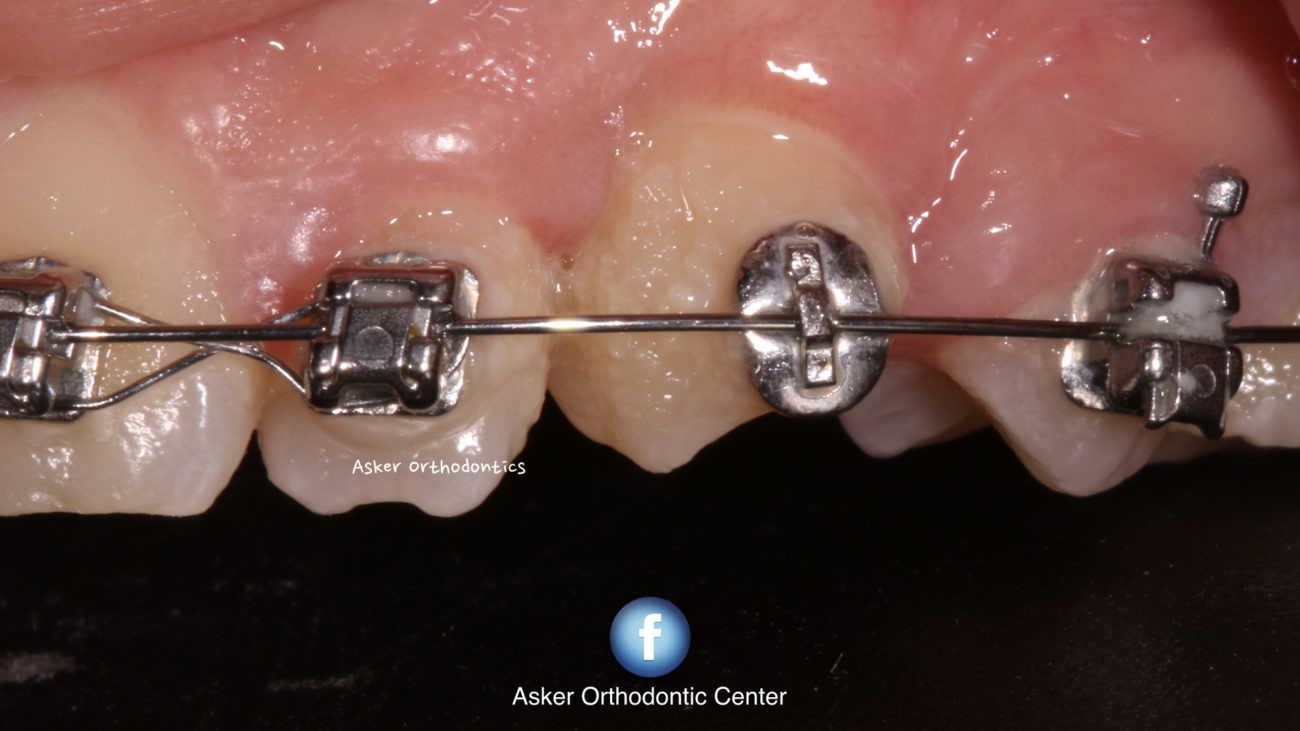 palatally impacted canine image