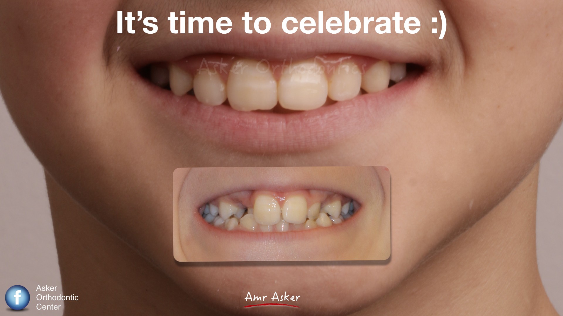 Full lateral cross bite case, step by step image