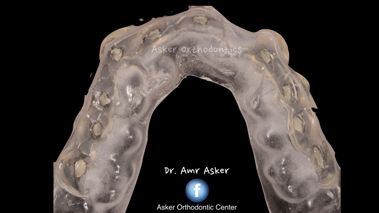 Indirect bonding image