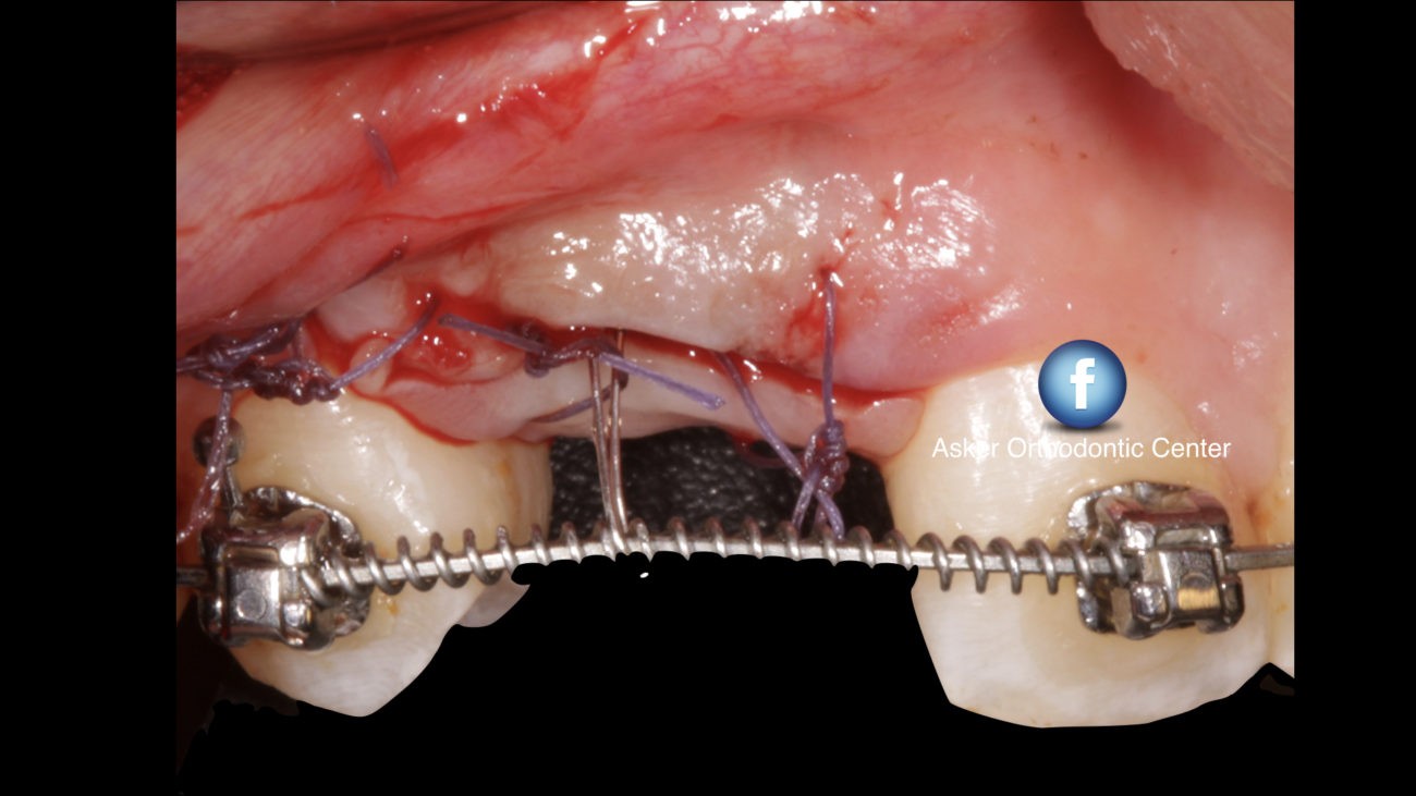 Labial impacted canine image