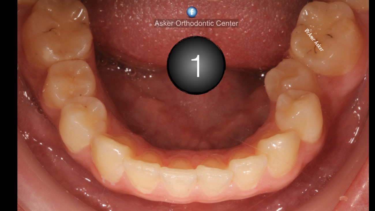 Lingually erupted 2nd premolar image