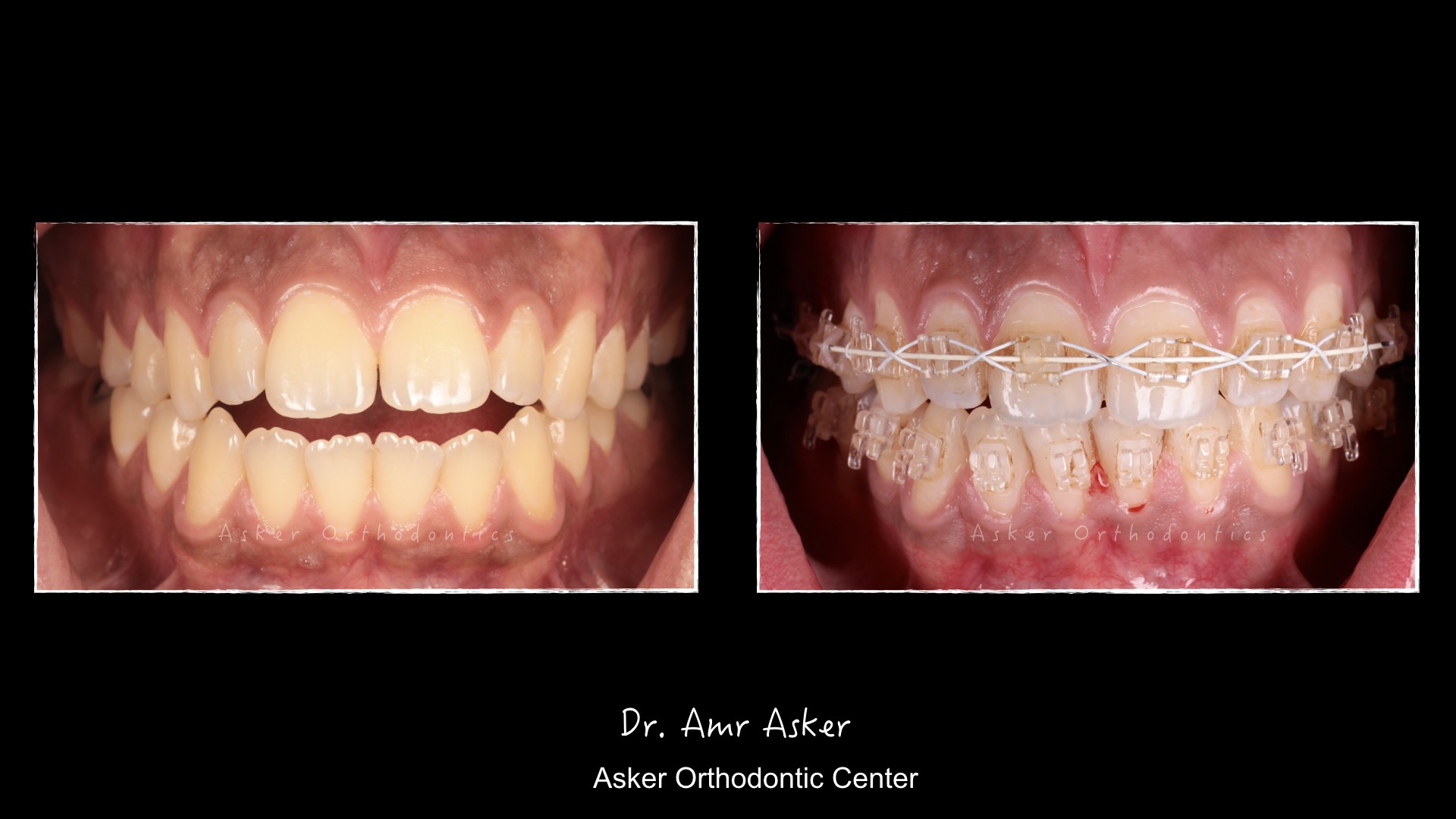Open bite+habit breaking, step by step image