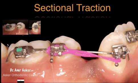 SECTIONAL ORTHODONTICS image